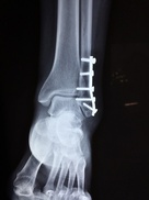 Röntgenbild einer Knöchelfaktur